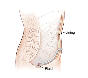 Side view of abdomen showing catheter inserted through body wall into abdominal cavity.