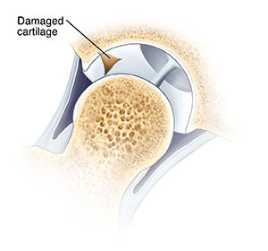 Cross section of hip joint with femoral head moved out of socket. Part of cartilage lining socket is damaged.