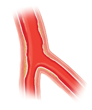 Cross section of artery with damaged inner lining.