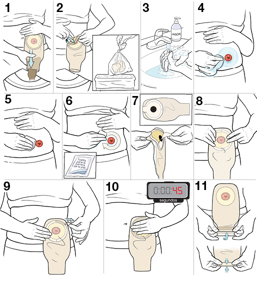 11 pasos para cambiar la bolsa del estoma.