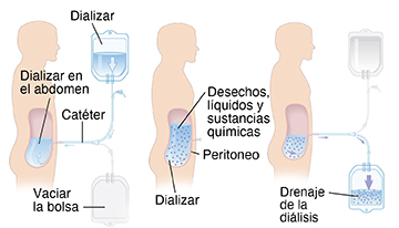 Vista lateral de un hombre donde se observan los tres pasos durante la diálisis peritoneal.