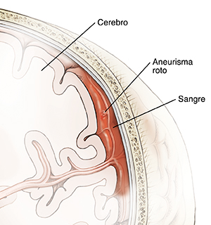 Corte transversal de un cerebro dentro de un cráneo en donde se muestra la ruptura de un aneurisma en un vaso sanguíneo en la superficie del cerebro.