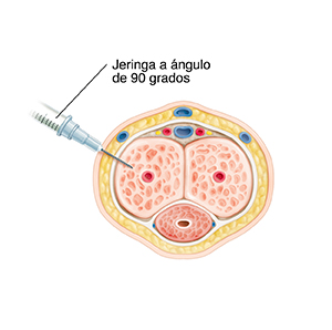 Corte transversal de pene blando con jeringa que demuestra cómo aplicarse una autoinyección peneana.