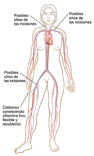 Vista frontal de un contorno de mujer en el que pueden verse el corazón, las venas y arterias principales. Se ve un catéter insertado en la vena femoral que va hasta el lado derecho del corazón.